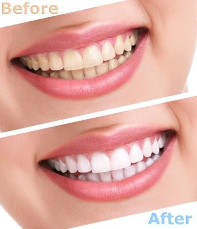 teeth whitening treatment in Longview, TX